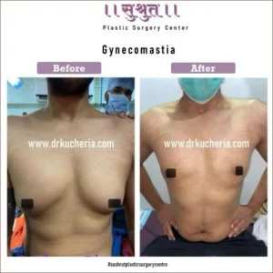 Gynecomastia Doctor in Indore