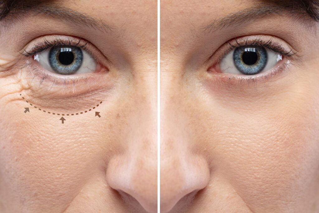 Blepharoplasty Surgery
