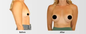 Breast Enlargement Services