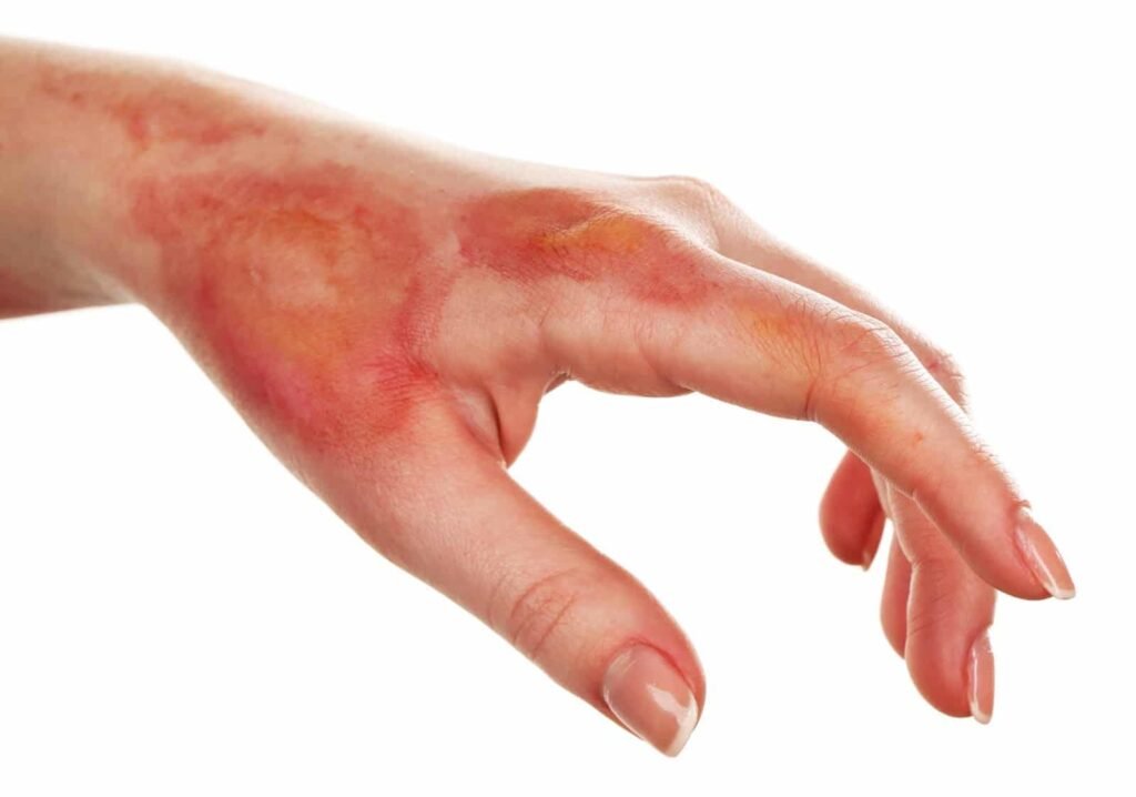 Scald Burn Treatment in Indore