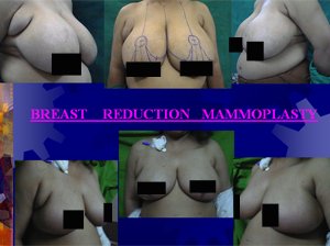 Breast Lift Surgery in Indore