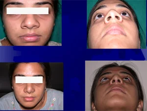 Nose Correction Surgery Indore