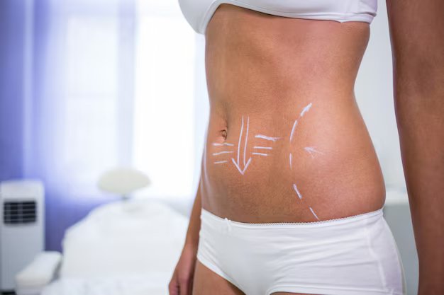 Abdominoplasty Surgery in Indore