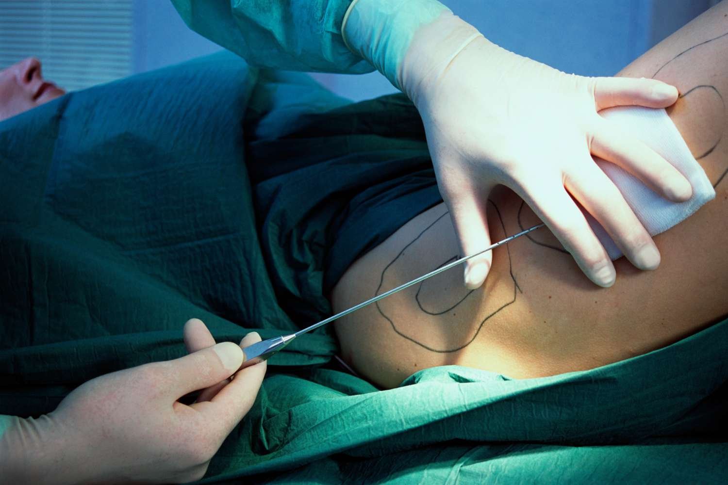 Plastic Surgery Doctors In Indore