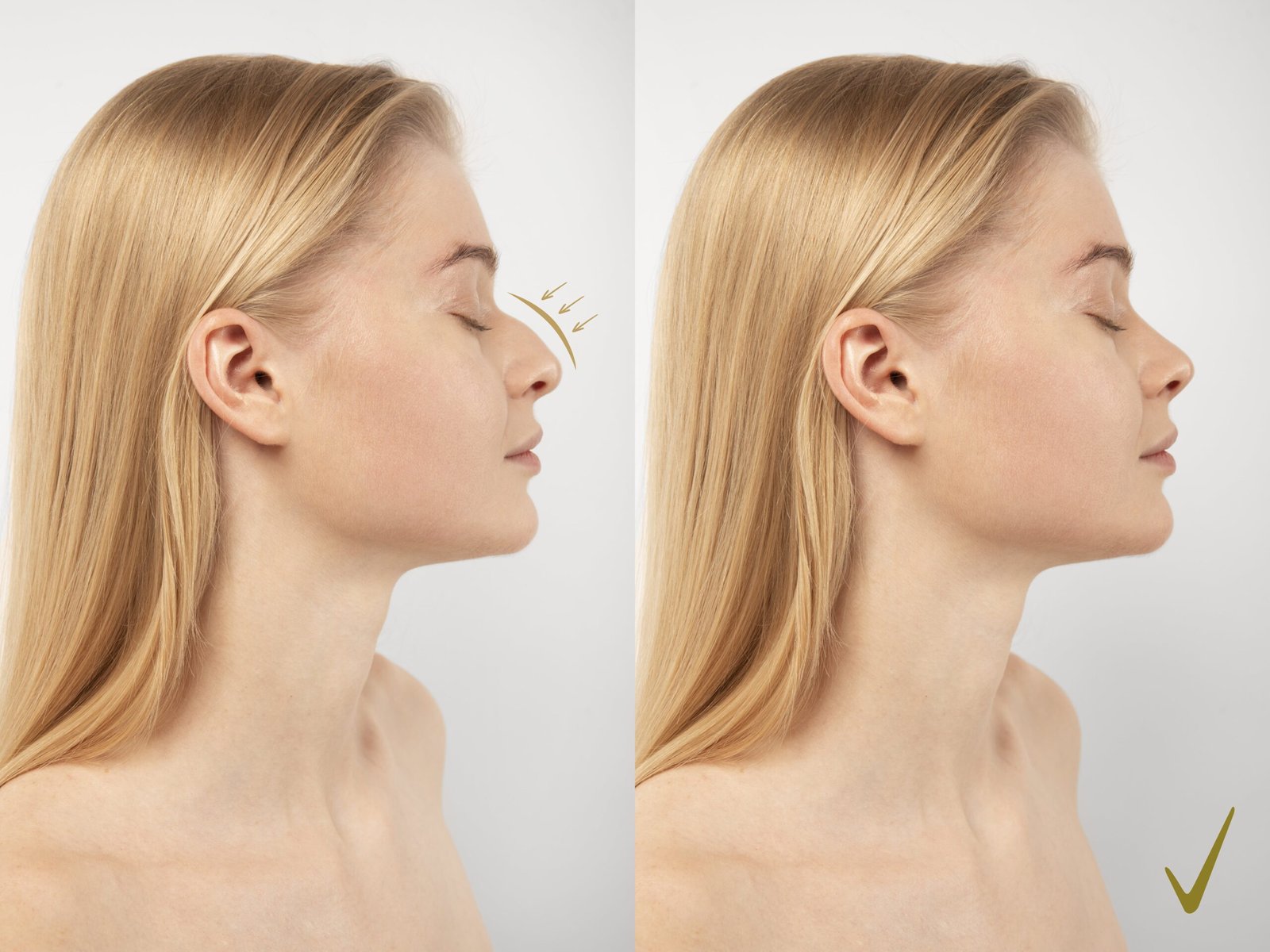 Nose Surgery in Indore