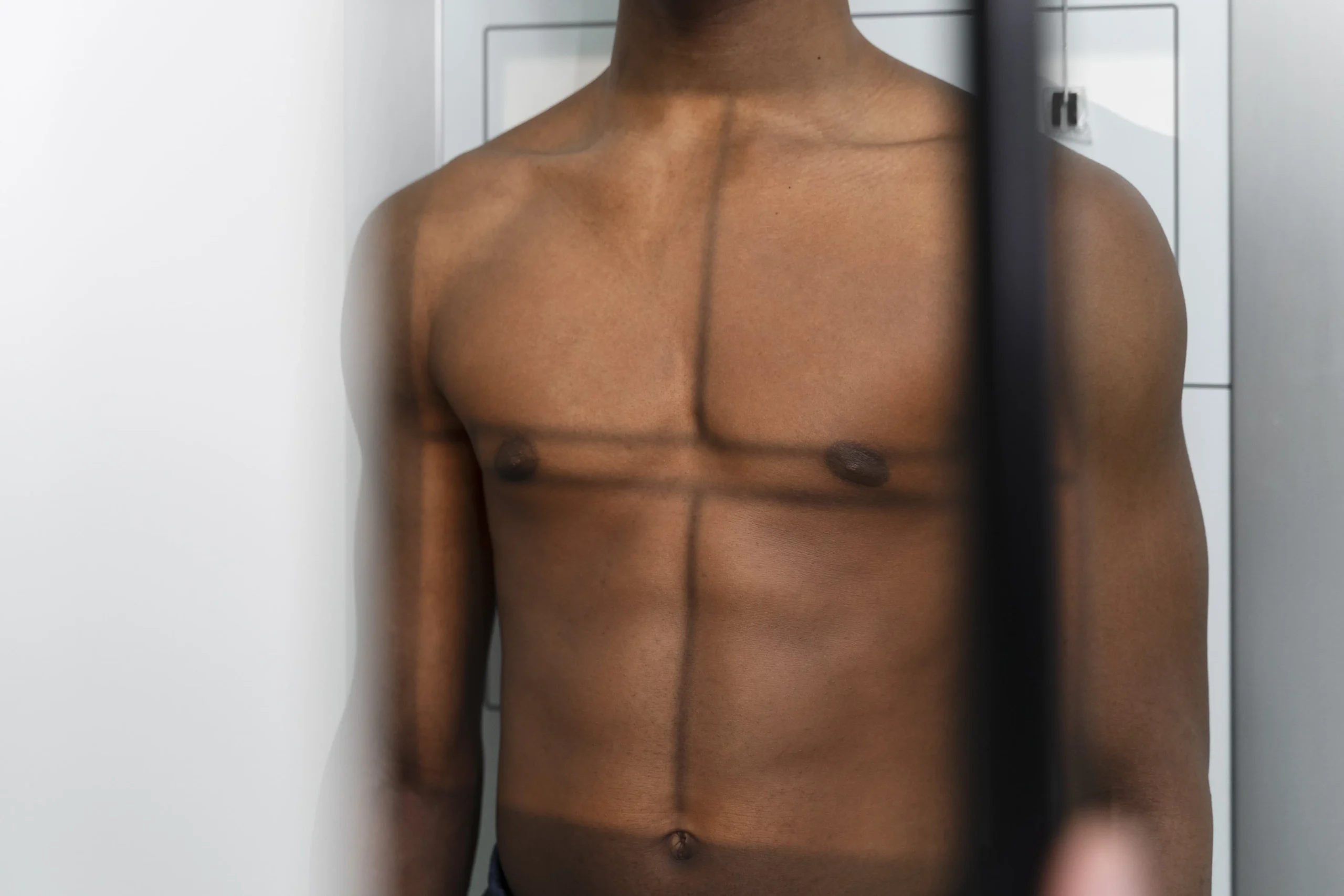 Before and after results of Gynecomastia Scar Treatment in Indore by Dr. Sanjay Kucheria