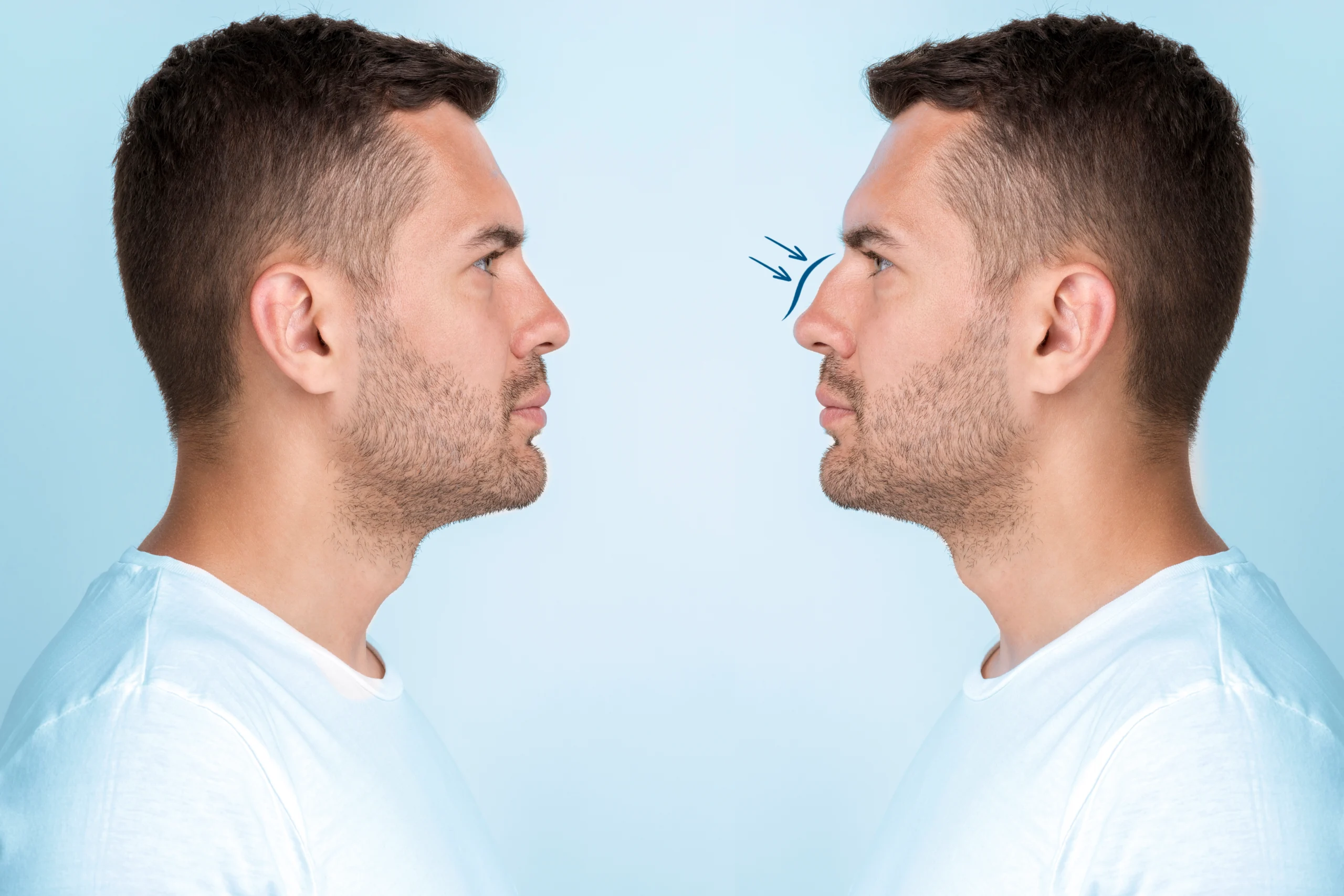 Male Rhinoplasty in Indore by Dr. Sanjay Kucheria for masculine facial enhancement.