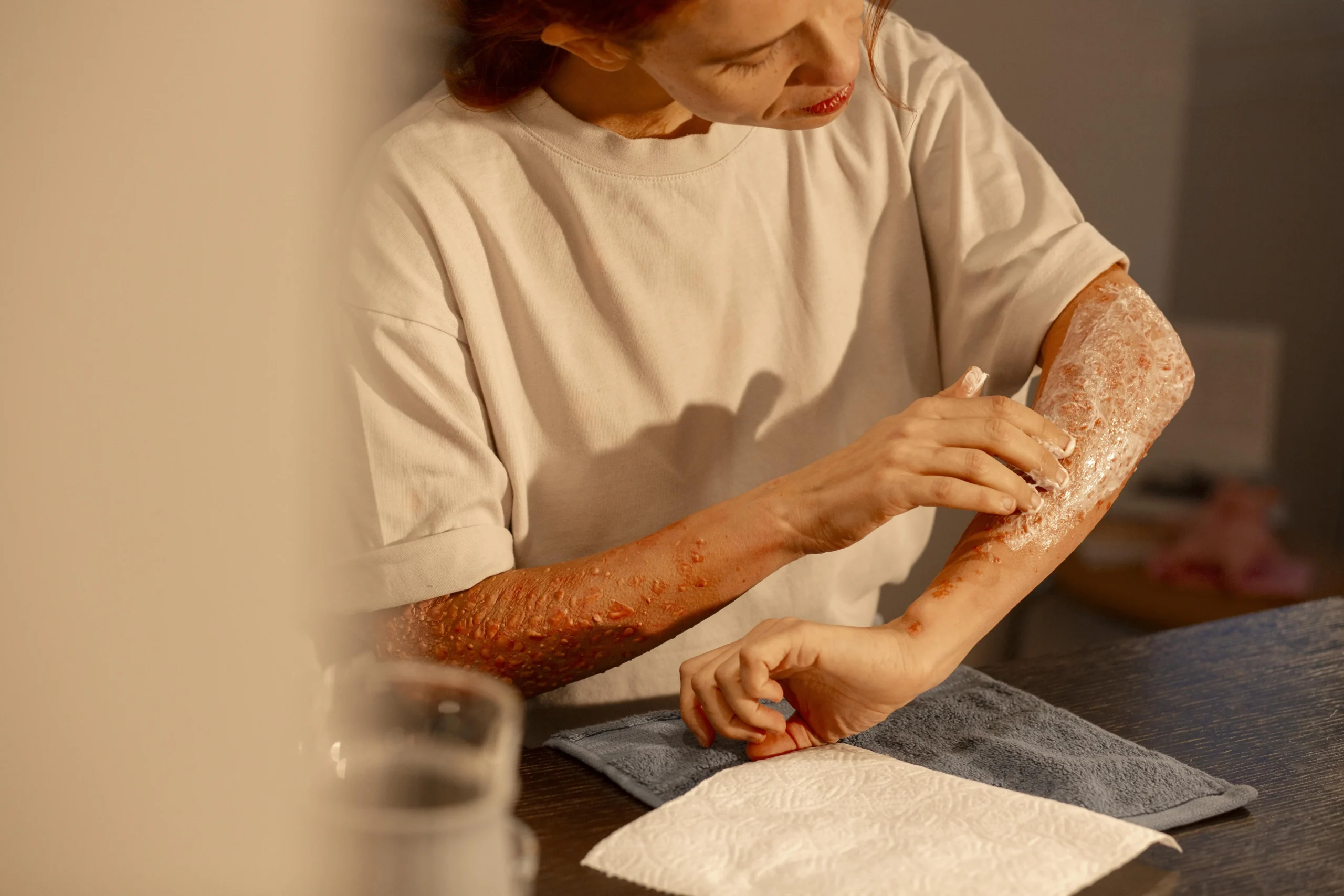 Burn scars and deformity correction treatment results by Dr. Sanjay Kucheria in Indore